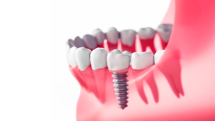 imagen de implantes dentales en navarra mutilva